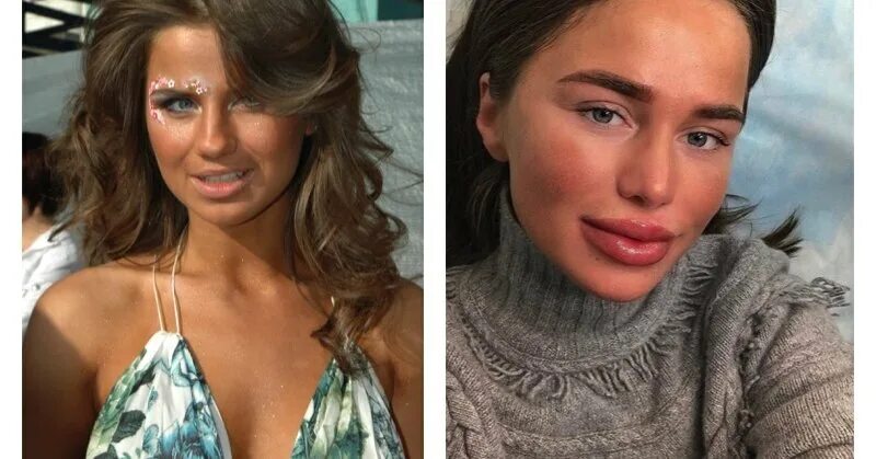 Алекса певица фото до и после пластики Алекса удалила фотографии своих "новых" губ, которые шокировали ее поклонников
