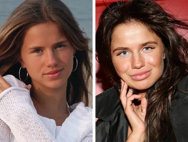 Алекса пластика фото Юлия Волкова, Алекса, Елена Корикова и другие звезды, которых не спасла пластика