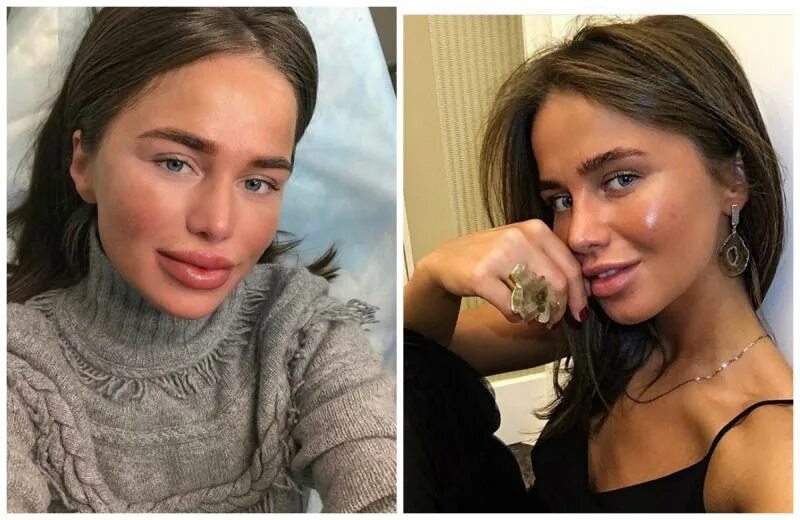 Алекса пластика фото Экс-участница "Фабрики" Алекса напугала фанатов лицом после пластики - 24СМИ