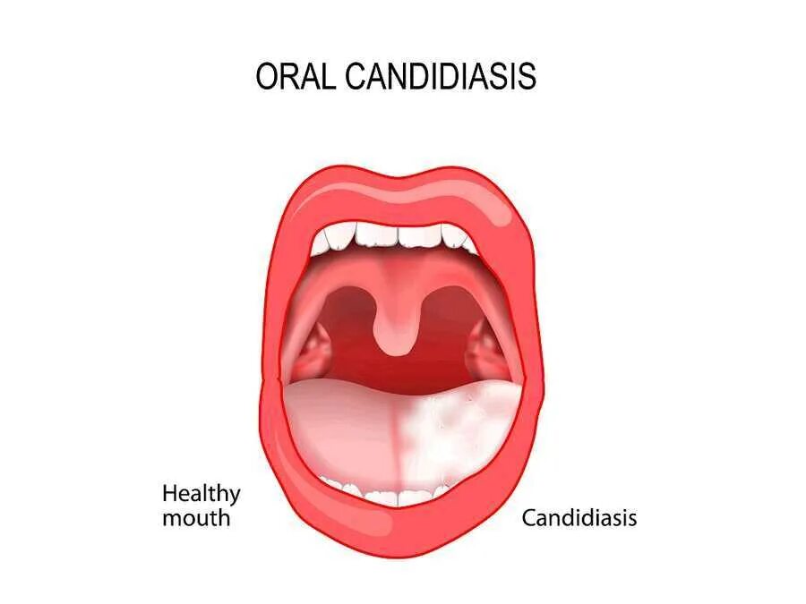 Кандидоз горла симптомы лечение фото The Pathophysiology of Oropharyngeal Candidiasis - Treating Fungus