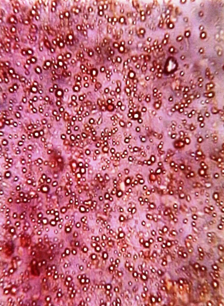 Кандидоз кожи симптомы фото Parasites