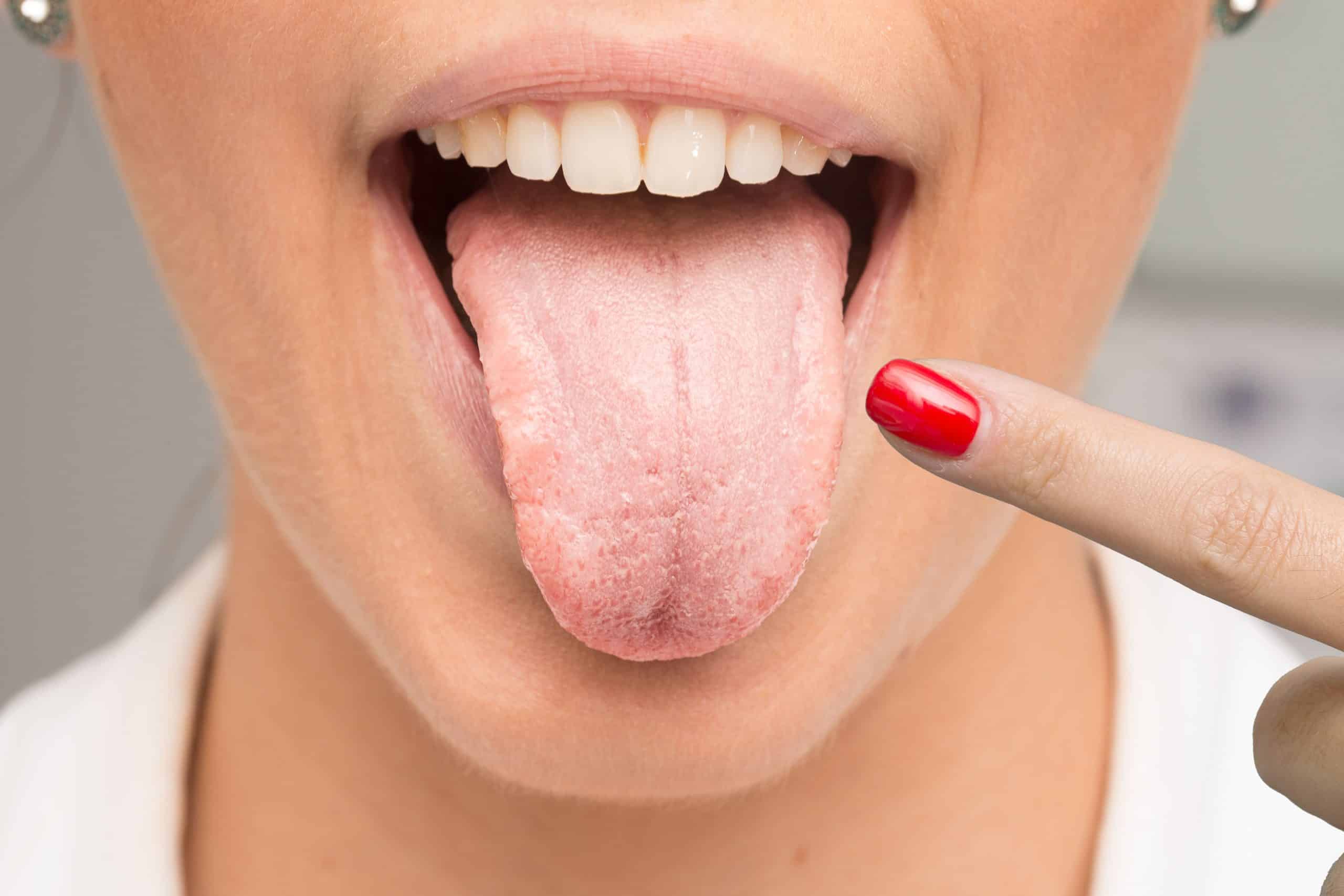 Кандидоз мягких тканей фото Pink Saliva Factory Sale mail.smartmed-nsk.ru