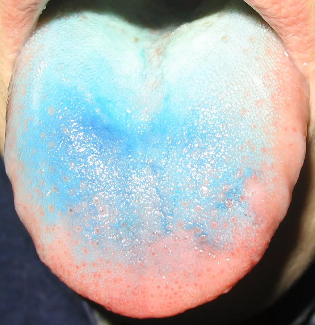 Кандидоз неба фото File:Blue tongue.jpg - Wikipedia