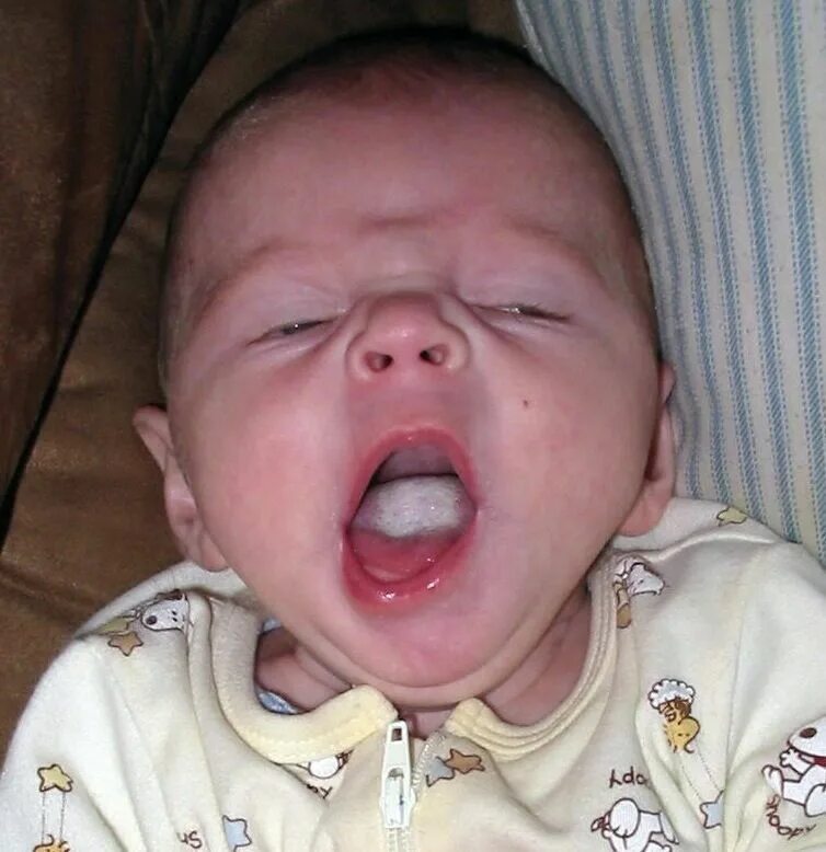 Кандидоз неба фото Pin on pregnancy, mama, baby: stuff to read