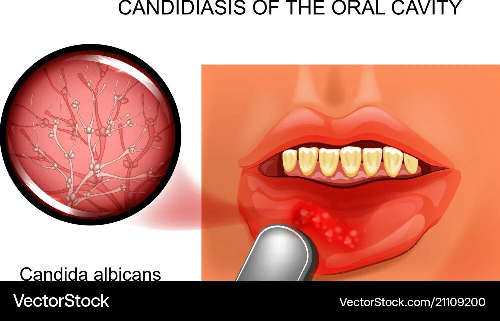 Кандидоз неба фото Candidiasis of the oral cavity Royalty Free Vector Image