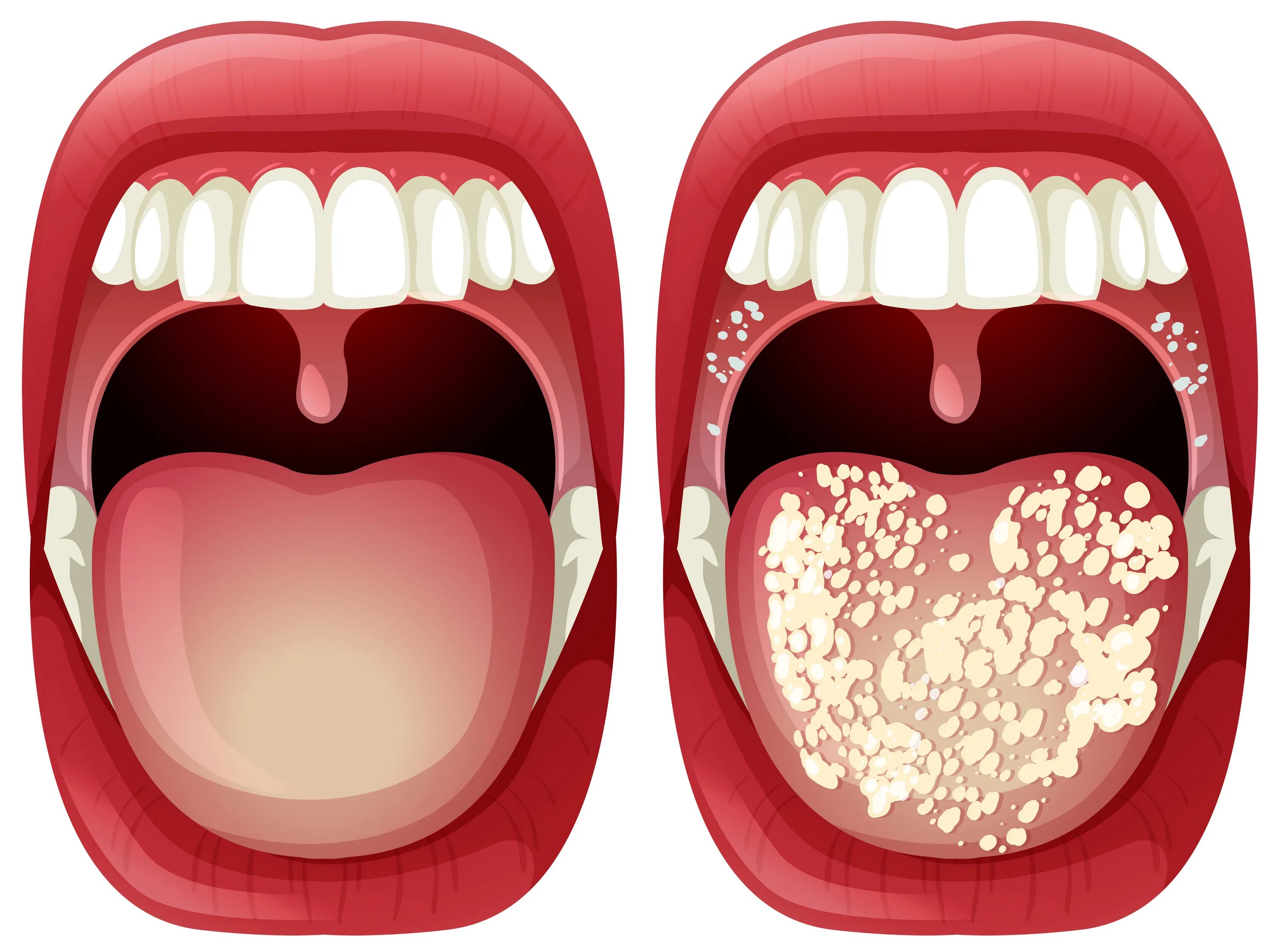 Кандидоз неба фото Vector of Healthy and Virus Mouth 298898 Vector Art at Vecteezy