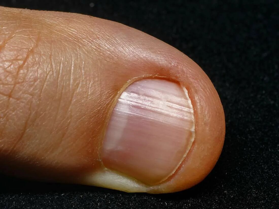 Кандидоз ногтей фото No half-moon on nails: What does it mean? Chronic obstructive pulmonary disease,