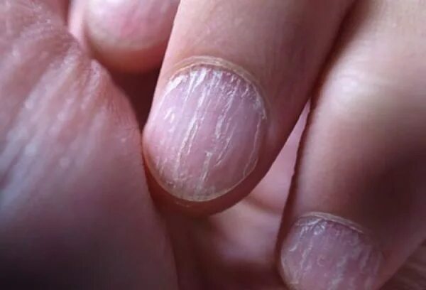 Кандидоз ногтей фото Salt for nail fungus Blog Pilochka