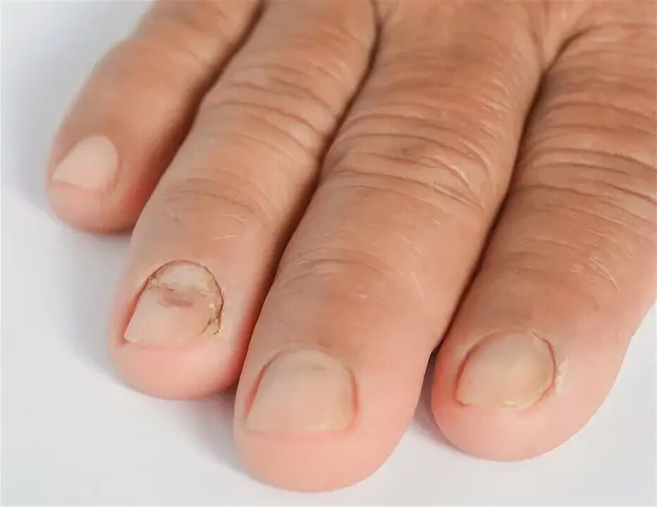 Кандидоз ногтей фото Nail Psoriasis Images - Browse 1,572 Stock Photos, Vectors, and Video Adobe Stoc