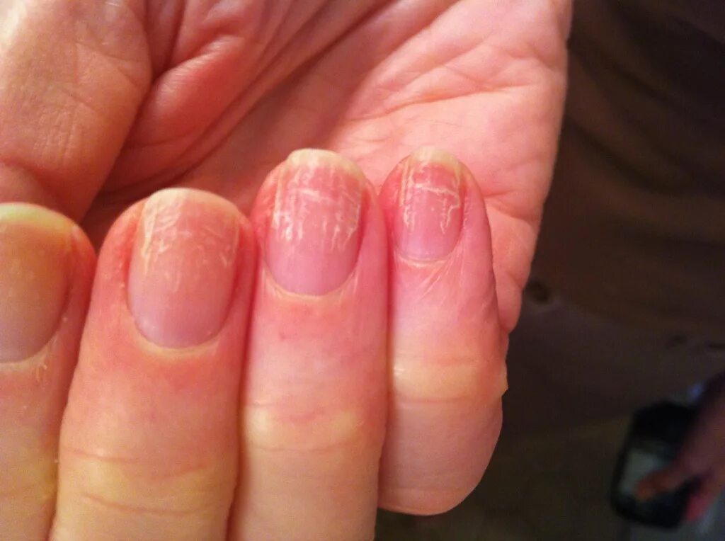 Кандидоз ногтей фото Nail Dystrophy in a Nurse vgrd-Bleacher-Report