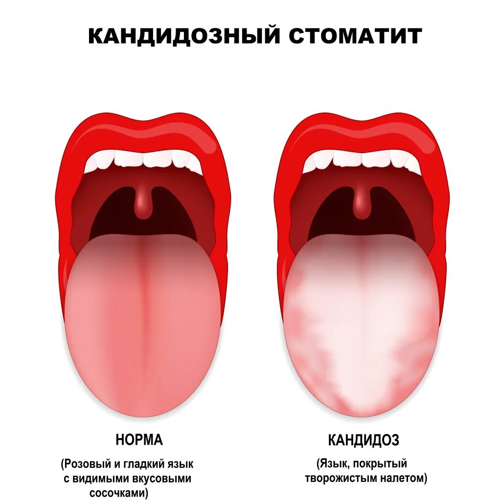 Кандидоз полости рта фото симптомы лечение Кандидозный стоматит - симптомы острой и хронической форм, стадии и признаки у м