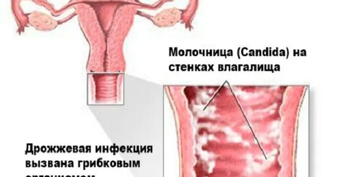Кандидоз у женщин фото снаружи Как выглядит мужская молочница - Арт Минск.ру