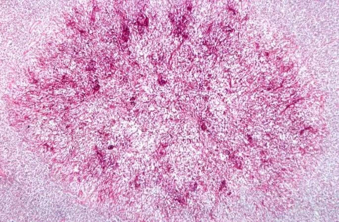 Кандидоз у женщин фото снаружи Candida vulvovaginitis pathophysiology - wikidoc