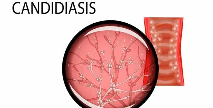 Кандидоз у женщин симптомы фото Pin en infecciones