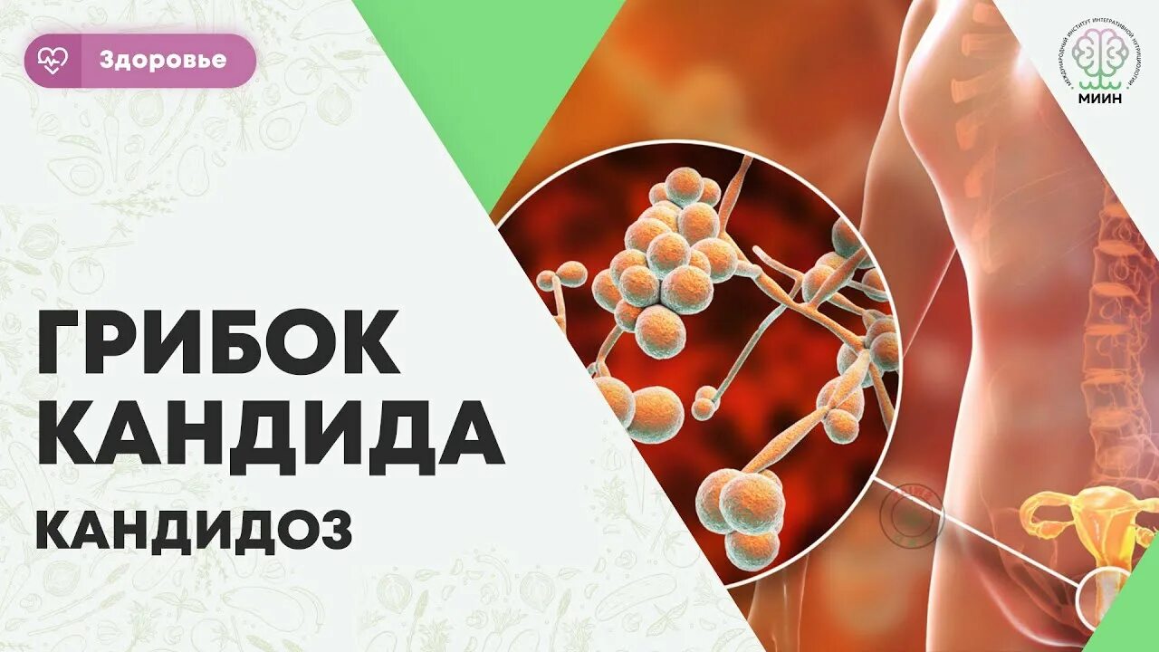 Кандидоз у женщин симптомы фото ЗДОРОВЬЕ Грибок Кандида. Кандидоз. Candida откуда берется, факторы риска, диагно
