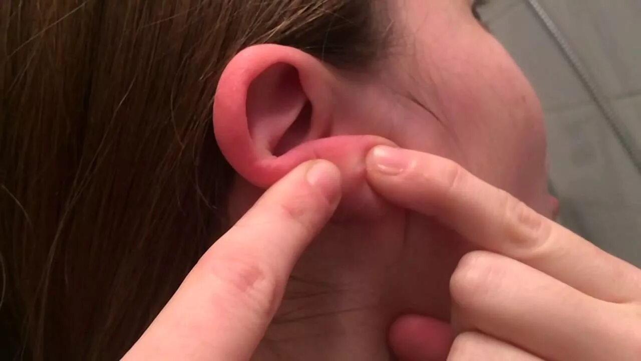 Кандидоз уха фото earlobe pimple poppin!! (120fps slow motion) - YouTube