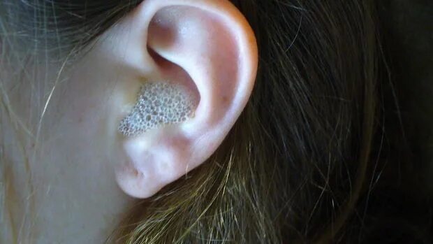 Кандидоз уха фото EAR SPA - 2 - English Hydrogen peroxide uses, Cleaning your ears, Hydrogen perox