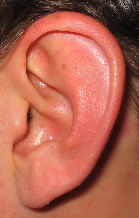 Кандидоз уха фото Файл:Ear.jpg - Википедия