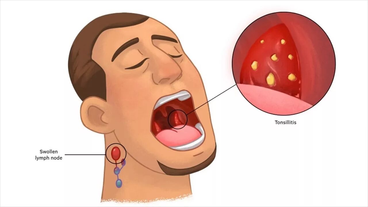 Кандидоз уха фото Dietary Recommendations For Tonsillitis- Which Food To Avoid And Which Food To T