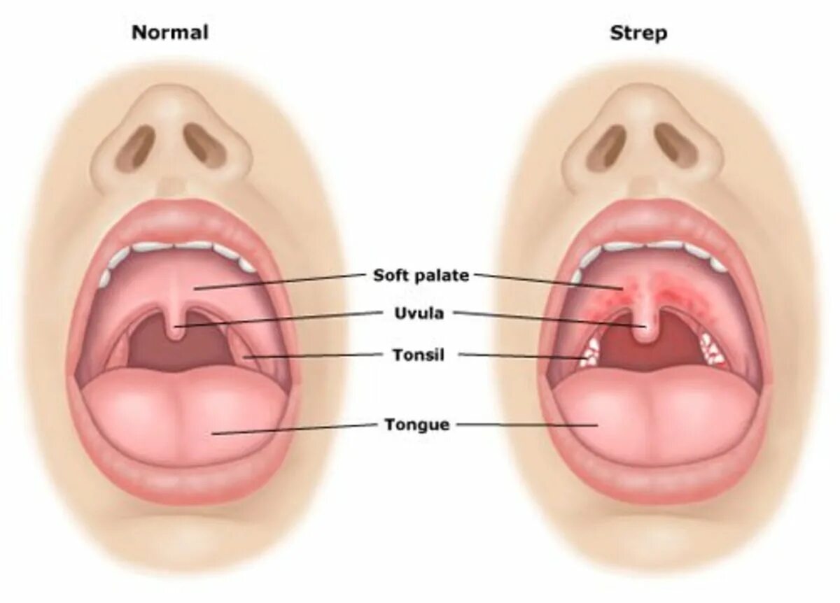 Кандидоз в горле у ребенка фото Home Remedies for Sore Throat Relief - RemedyGrove