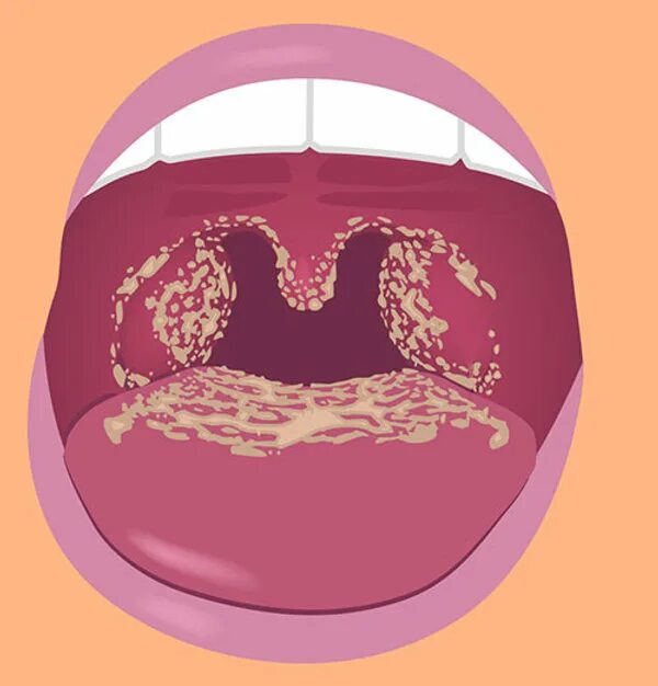 Кандидоз в горле у ребенка фото Candida Can Cause Dysphagia: A Closer Look.