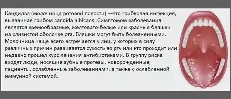 Кандидоз в горле у ребенка фото Язвочки на языке у ребенка: 6 признаков и причин, симптомы, 7 методов лечения
