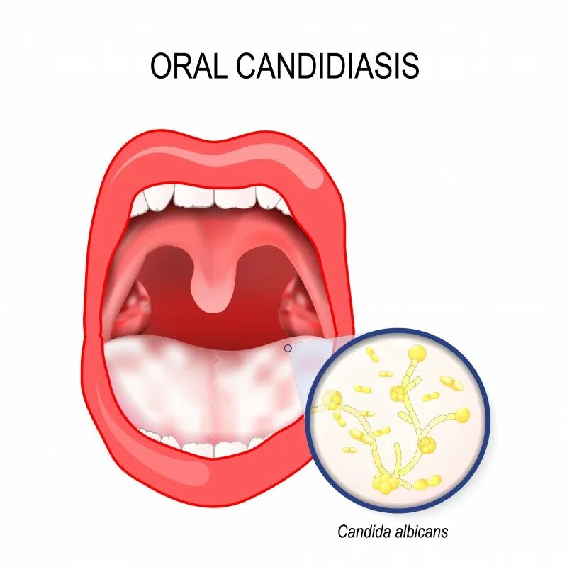Кандидоз в горле у ребенка фото What Is the White Film in My Mouth Rochester Zumbro Family Dental