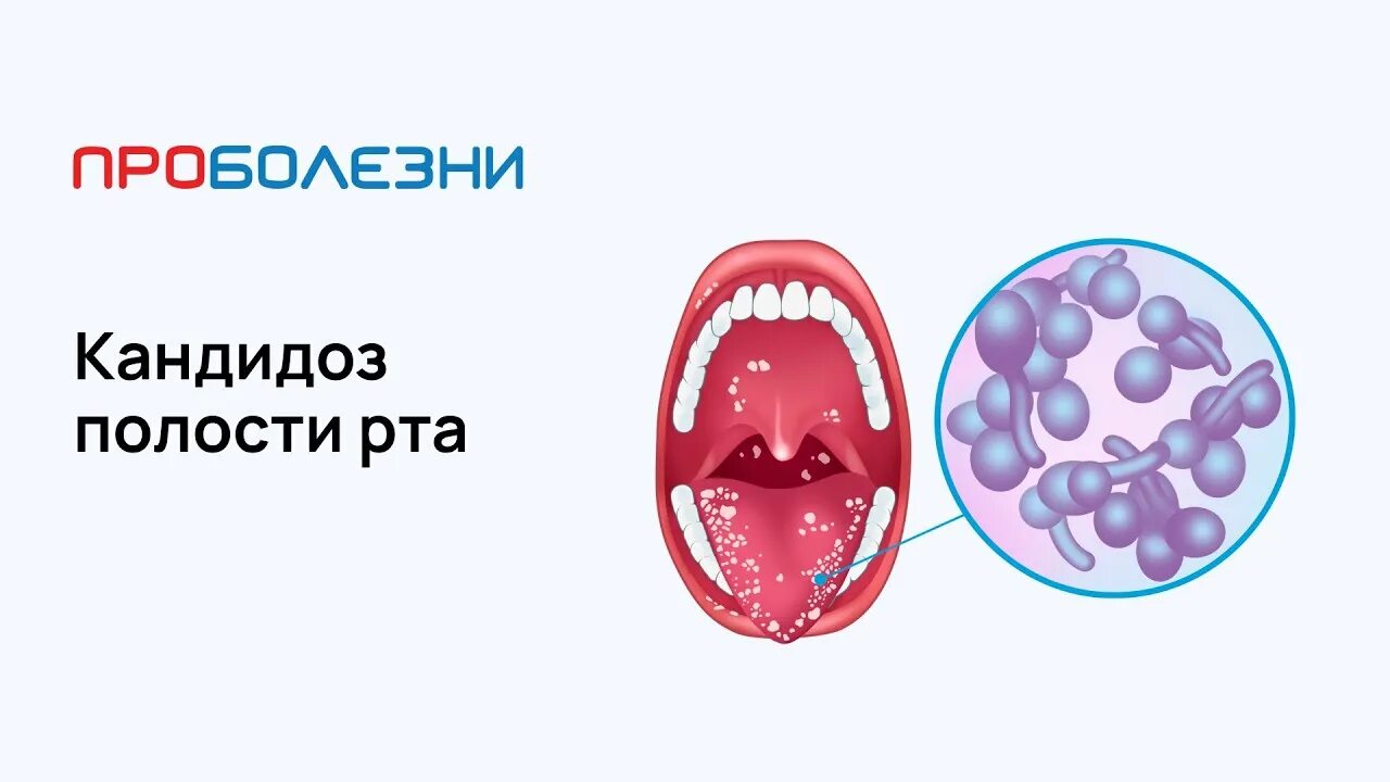 Кандидоз во рту симптомы фото Кандидоз полости рта - РКЦИБ Грозный