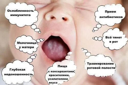 Кандидоз во рту симптомы фото Лечение молочницы во рту у детей: симптомы и средства для новорожденного и ребен