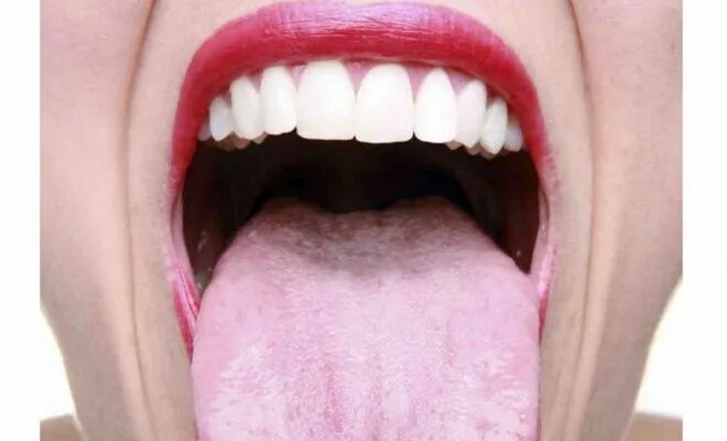 Кандидоз во рту симптомы фото Pin en health