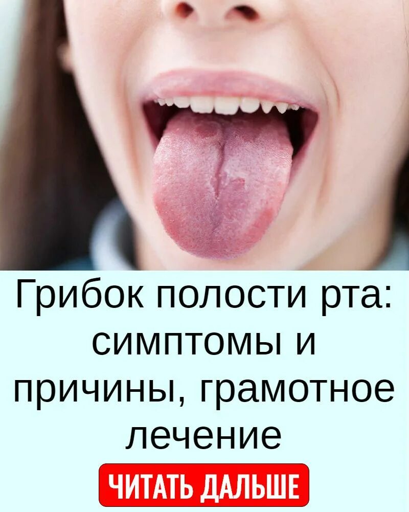 Кандидоз во рту симптомы фото Привкус мочи во рту