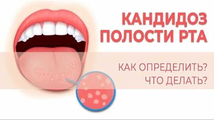 Кандидоз во рту симптомы фото После практики: разбираем вопросы студентов фармацевтического факультета... Инте