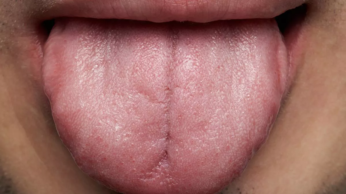 Кандидоз языка фото симптомы лечение Weird tongue symptom that indicates 'you shouldn't be drinking coffee' - Mirror 