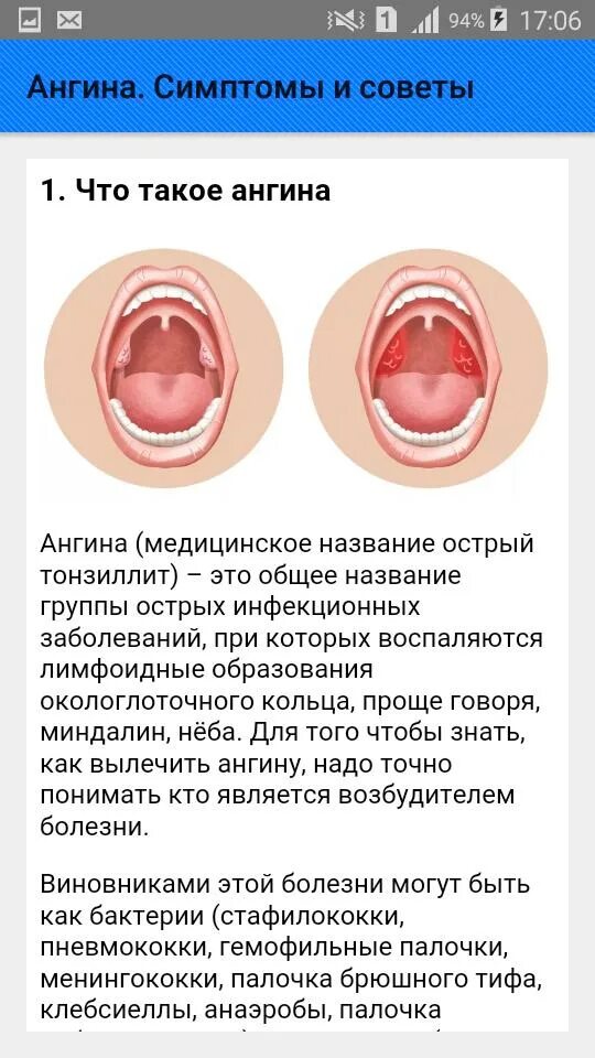Кандидозная ангина фото горла Ангина. Симптомы и советы APK for Android Download