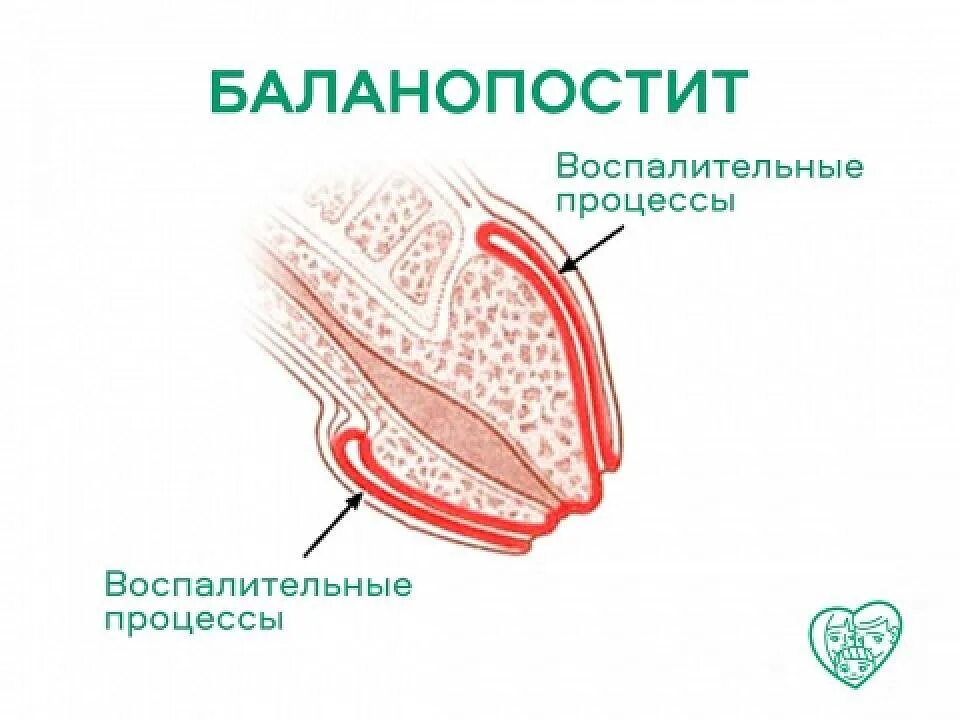 Кандидозный баланит у мужчин фото симптомы лечение Ok Баланопостит при эрекции