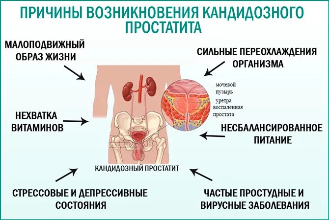 Кандидозный баланит у мужчин фото симптомы лечение Флуконазол при простатиті: дозування для пригнічення грибків