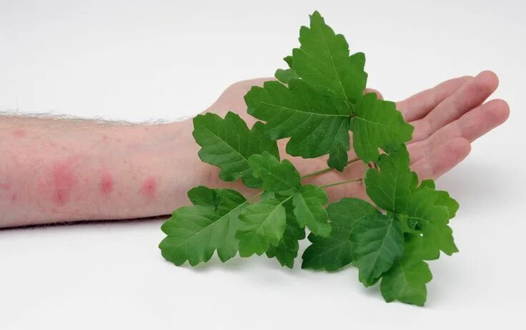 Кандидозный дерматит фото If you spend time outdoors, chances are you have been bothered by poison ivy, po