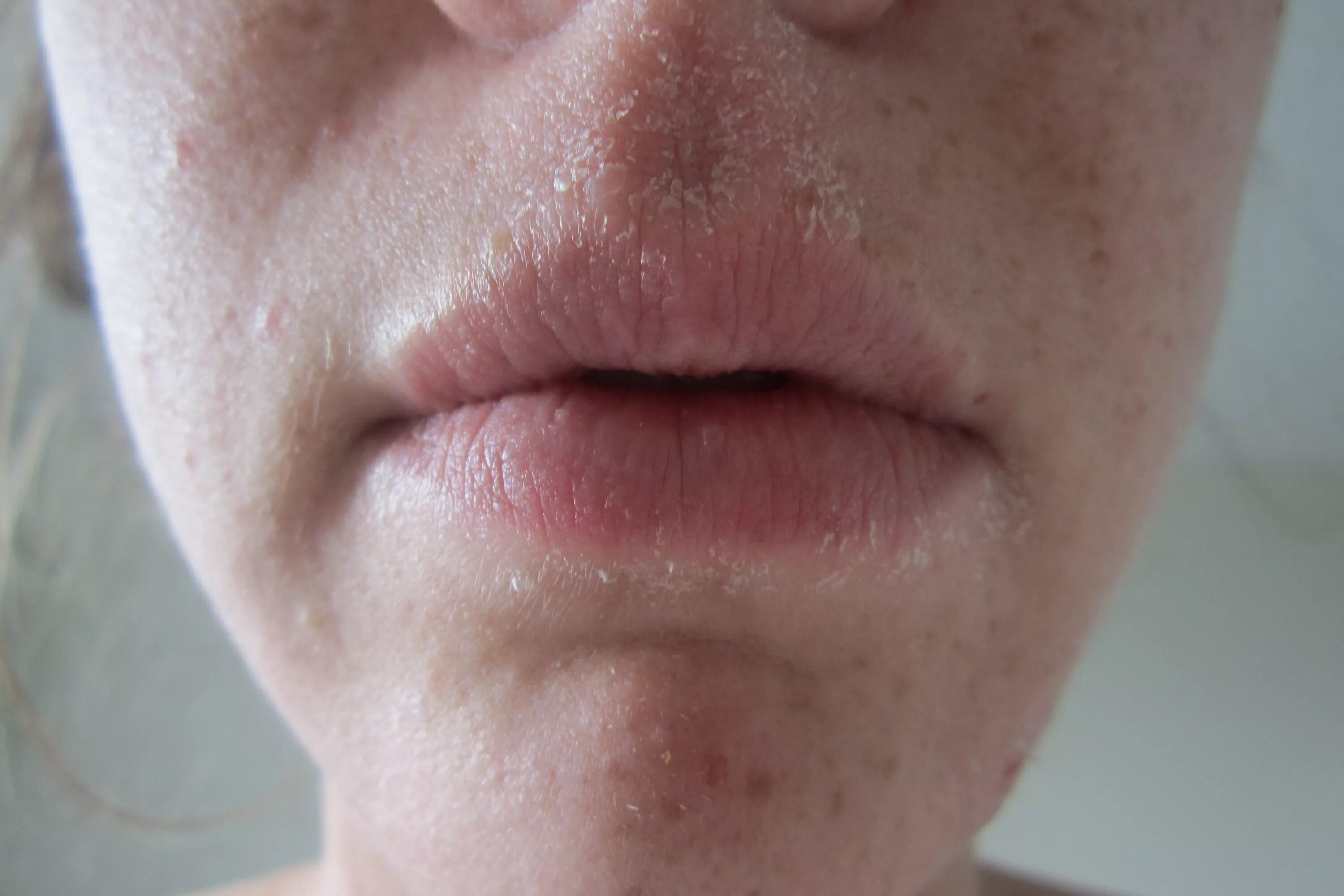 Кандидозный дерматит фото eczema The Hourglass Blogger