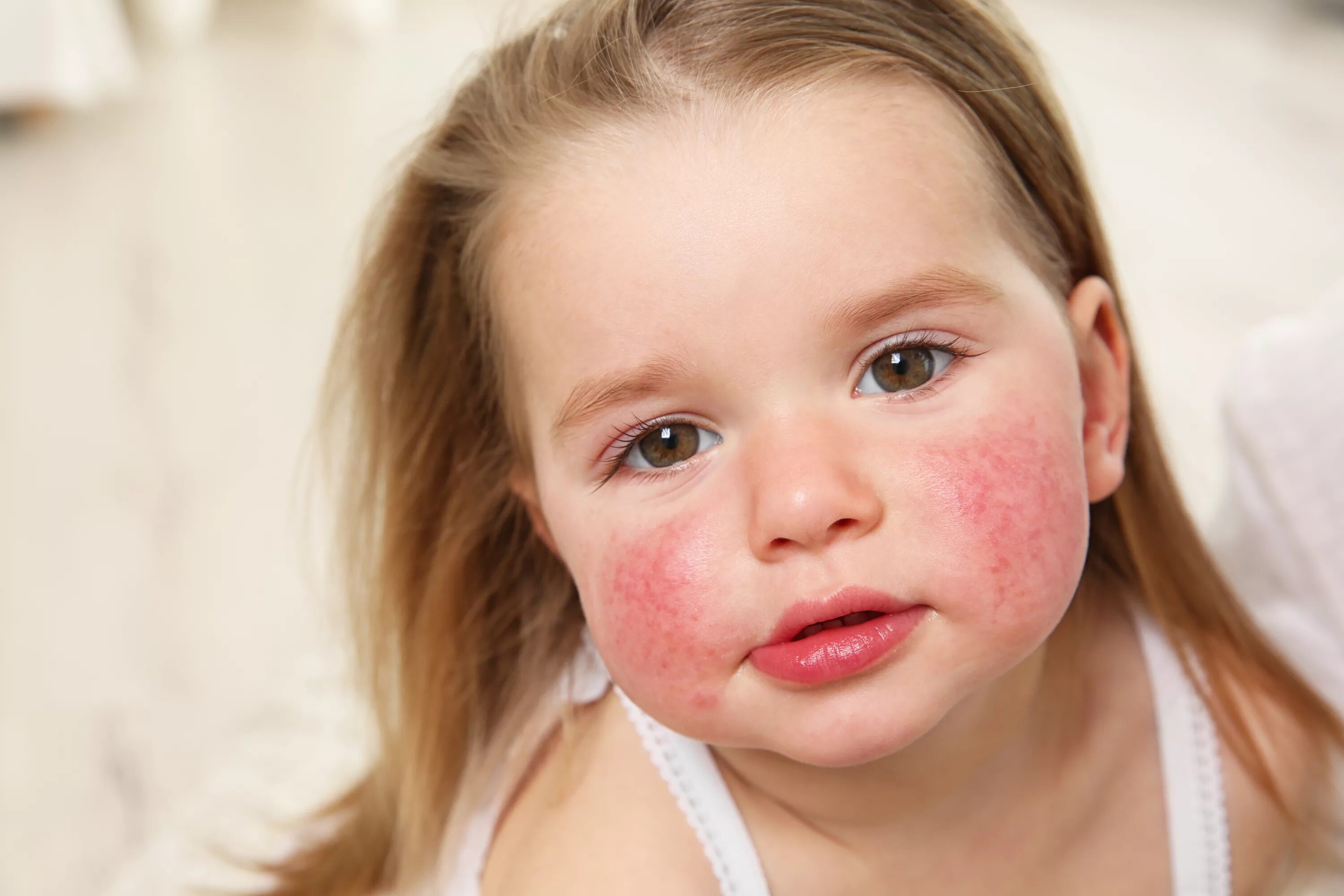 Кандидозный дерматит фото Food Allergy and Intolerance - Aine-Marie.com