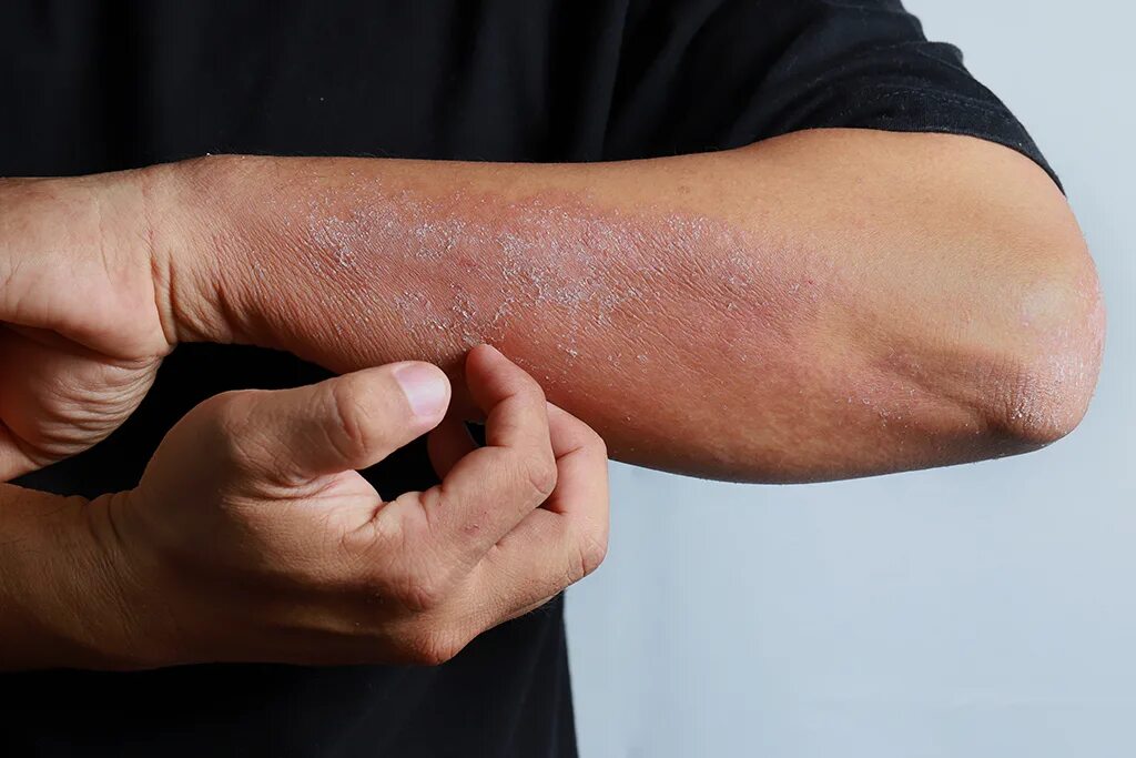 Кандидозный дерматит фото Reasons for Going to the Dermatologist Dermatologist in Southlake, TX