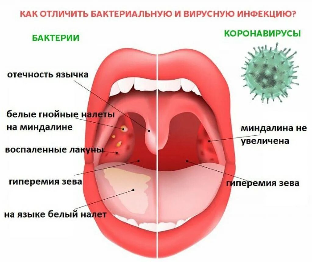 Кандидозный тонзиллит фото горла лечение у взрослых У ребенка сильно болит горло