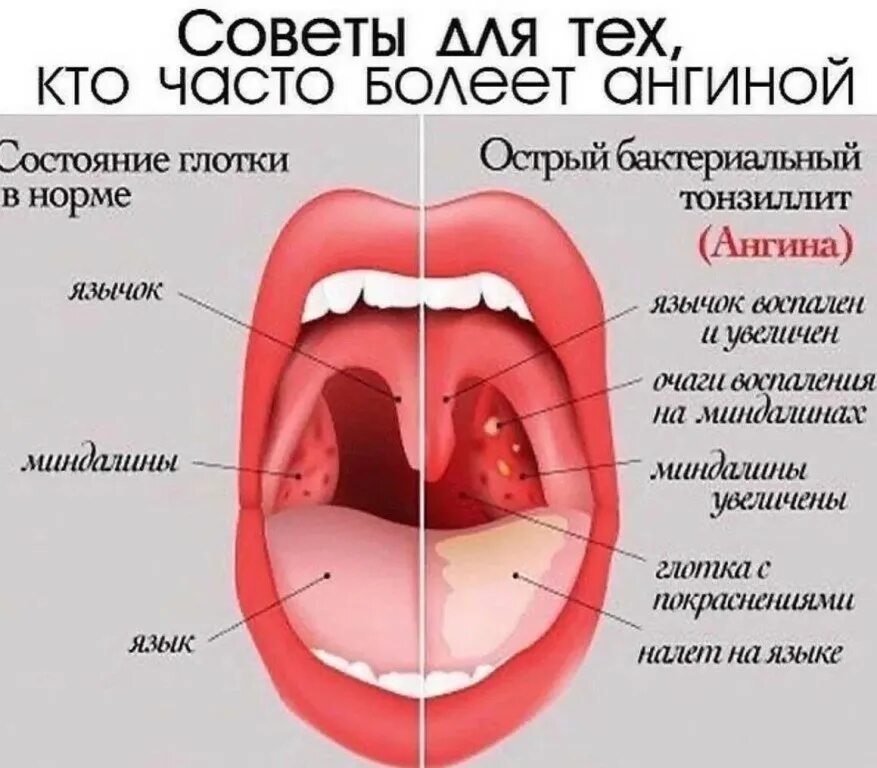 Кандидозный тонзиллит фото горла лечение у взрослых Советы для тех, кто часто болеет ангиной ⠀ ⠀ 1. Несколько раз в день полощите...