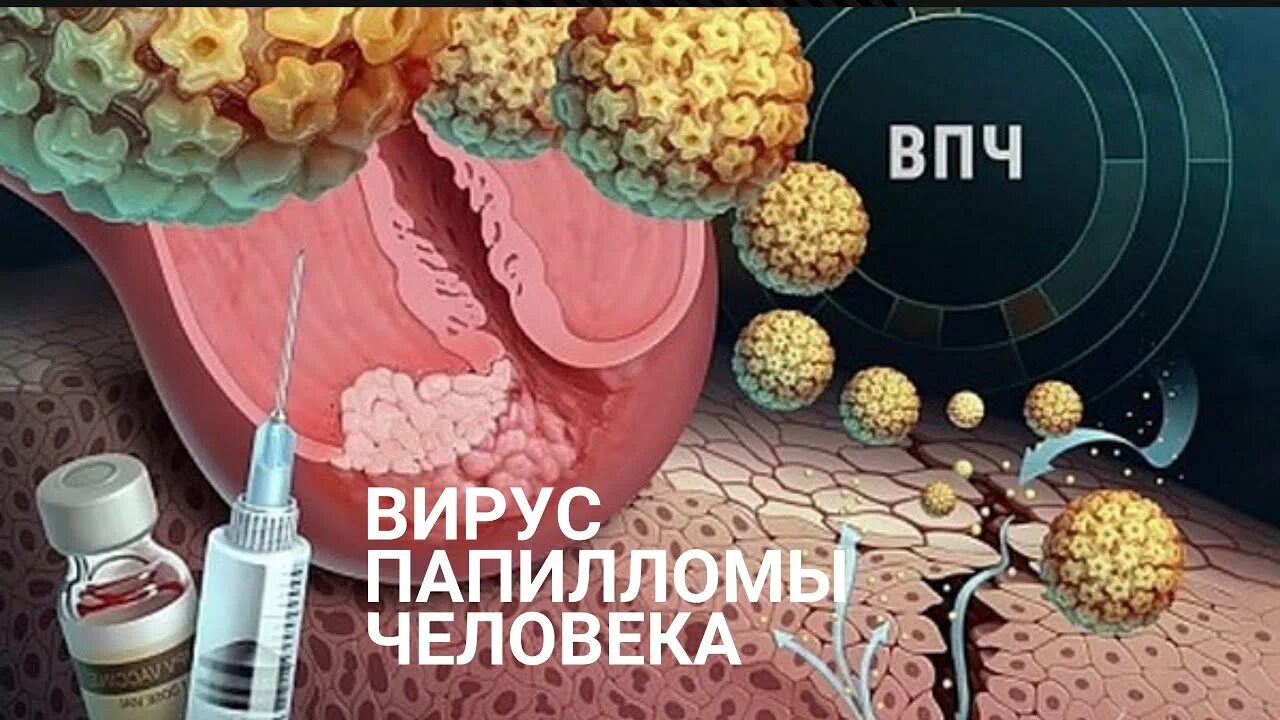 Кандилома вирус у женщин лечение фото таблетки Все о вакцинации от вируса папилломы человека (ВПЧ) - YouTube