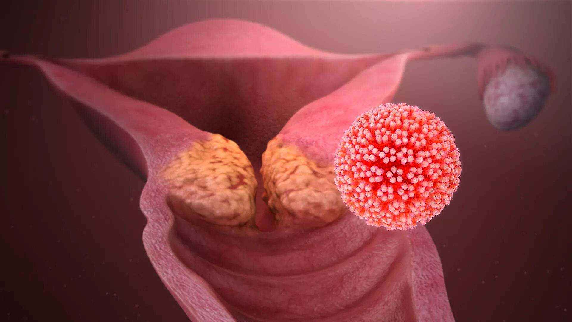 Кандилома вирус у женщин лечение фото таблетки File:HPV causing cervical cancer.jpg - Wikimedia Commons