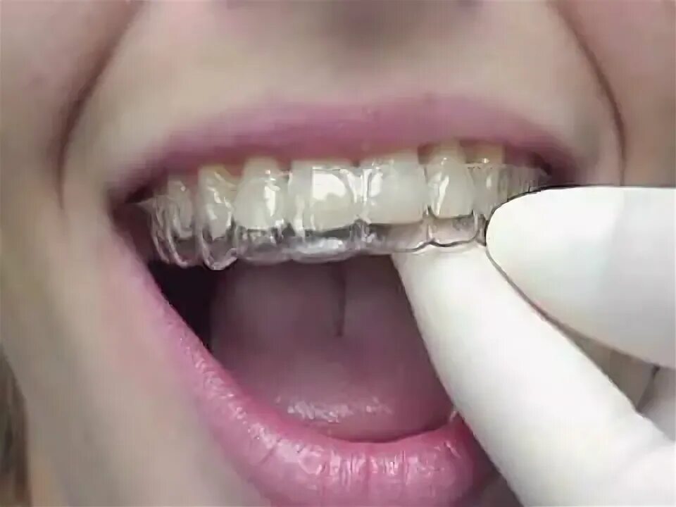 Кап для зубов фото Invisalign - YouTube