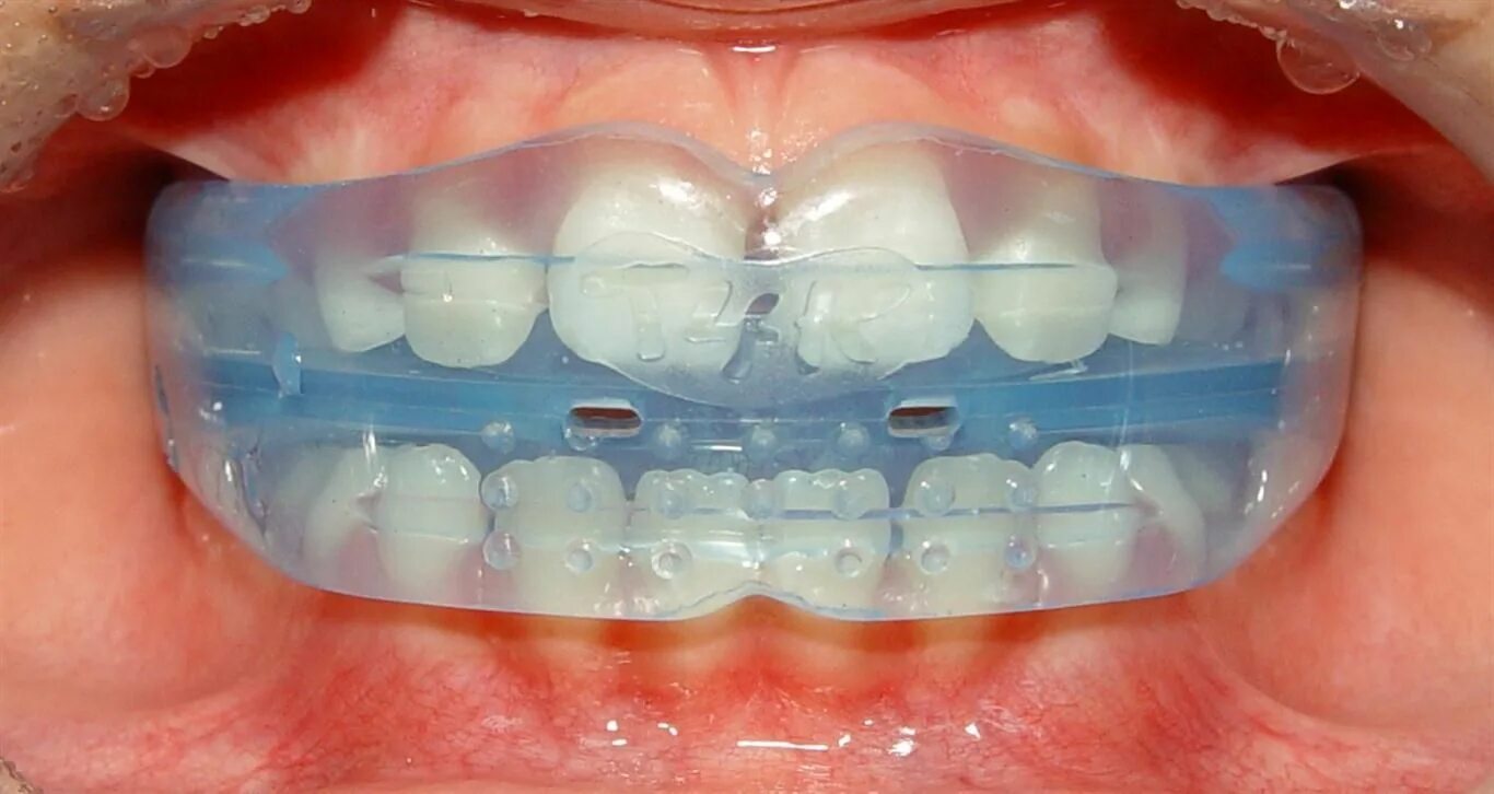 Кап для зубов фото Kevin O'Brien's blog on myofunctional orthodontics Orthodontics, Retainer teeth,