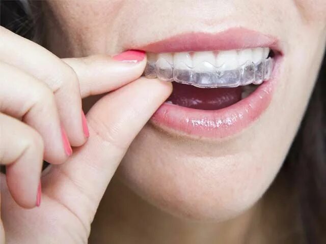 Кап для зубов фото Invisalign braces in Delhi