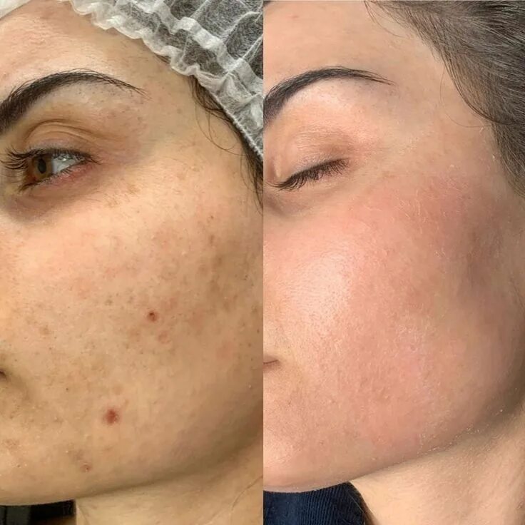 Капилляротерапия лица отзывы фото до и после Пилинг лица в Москве in 2024 Clear skin tips, Skin advice, Massage images