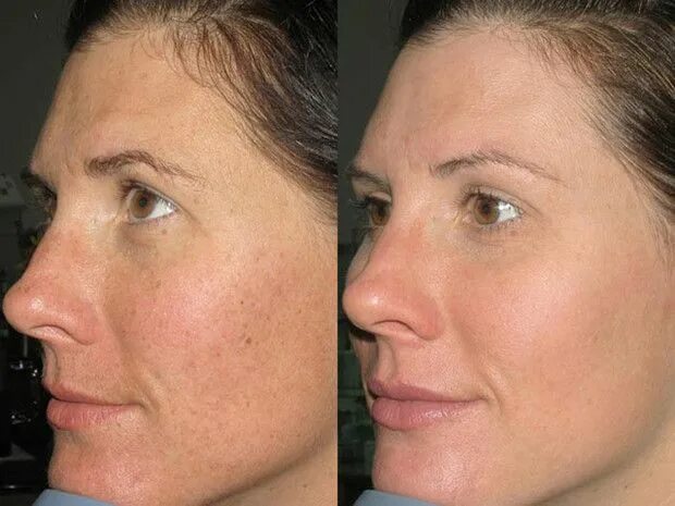 Капилляротерапия лица отзывы фото до и после Este pigment foltokkal az arcán feküdt le, reggel fehér bőrrel ébredt. Csodás ez
