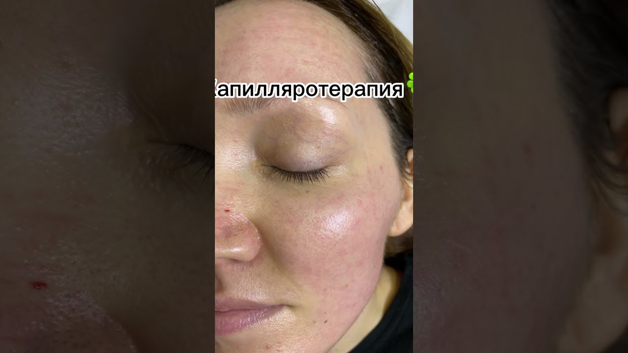 Капилляротерапия лица отзывы фото до и после Капилляротерапия, освежает лицо, придаёт блеск лица и устраняет мелкие морщинки#